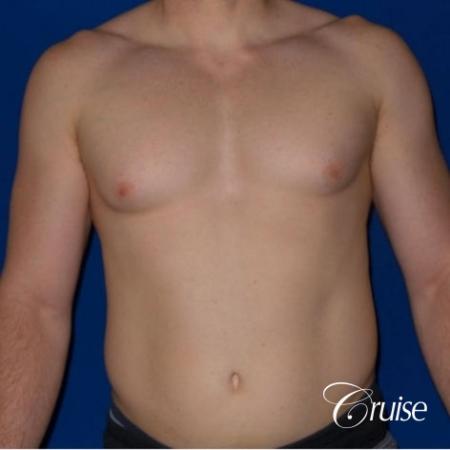 Dr. Cruise gynecomastia surgery photos - Before Image 1