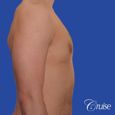 20 year old with moderate gynecomastia - After Image 4