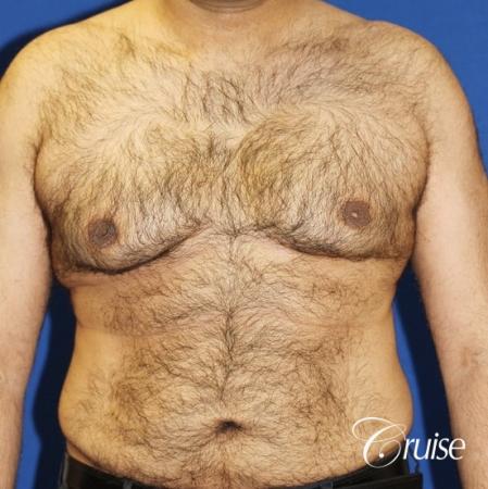40 year old with severe gynecomastia results - Before Image 1