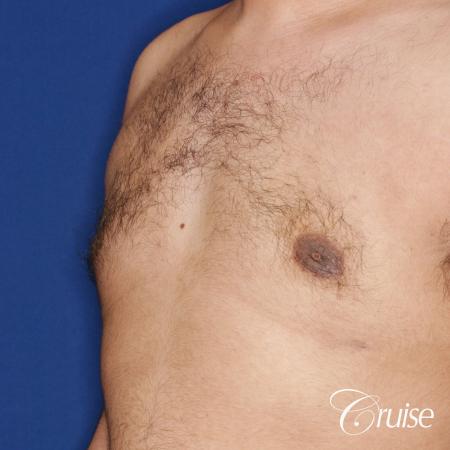 best scar on 32 gynecomastia patient - After Image 2