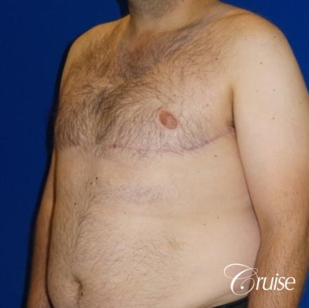 Severe Gynecomastia- Free nipple Graft - After Image 2