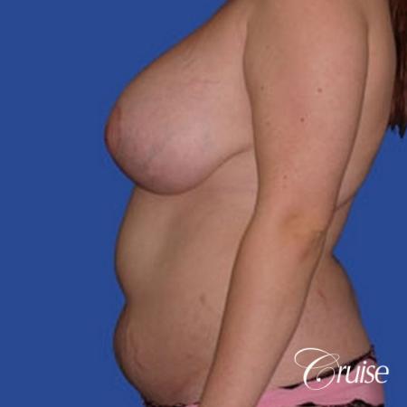 best before and after of liposuction abdomen, flanks, and upper back - Before and After Image 2