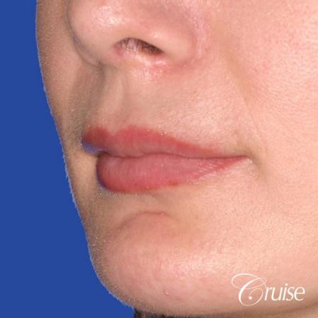 best before and after of lip filler - After Image 2