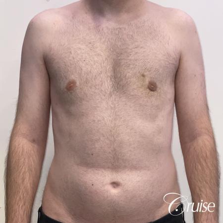 Gynecomastia: Patient 128 - After 1