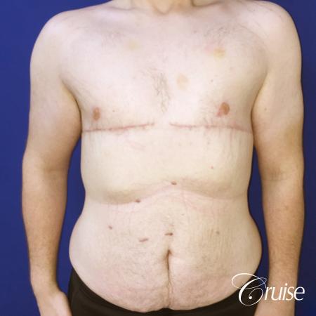 severe gynecomastia - After Image 1