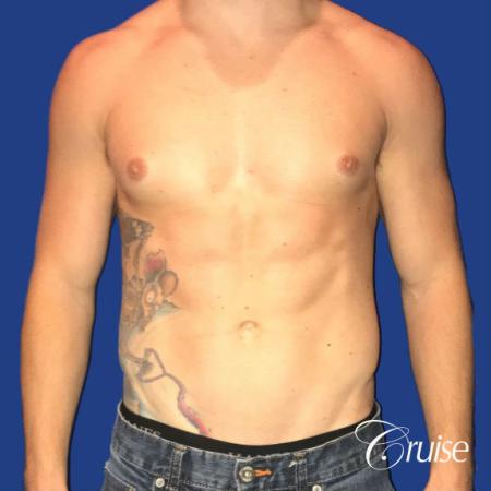 body builder puffy nipple gynecomastia - Before 1