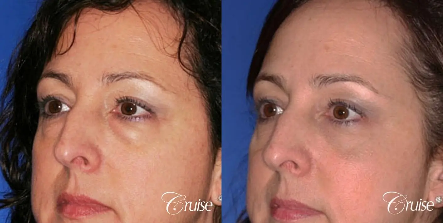 Blepharoplasty - Lower - Before and After 3