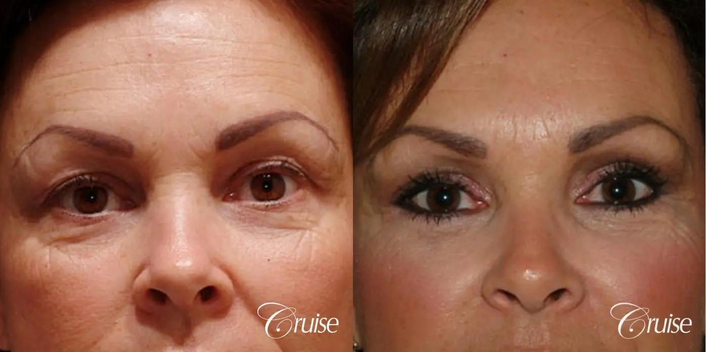 Blepharoplasty - Lower - Before and After  