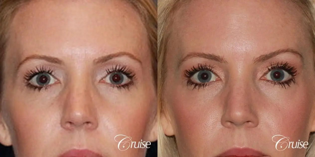 best upper eye lid results - Before and After