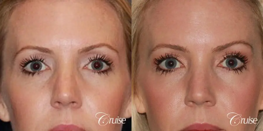 best upper eye lid results - Before and After