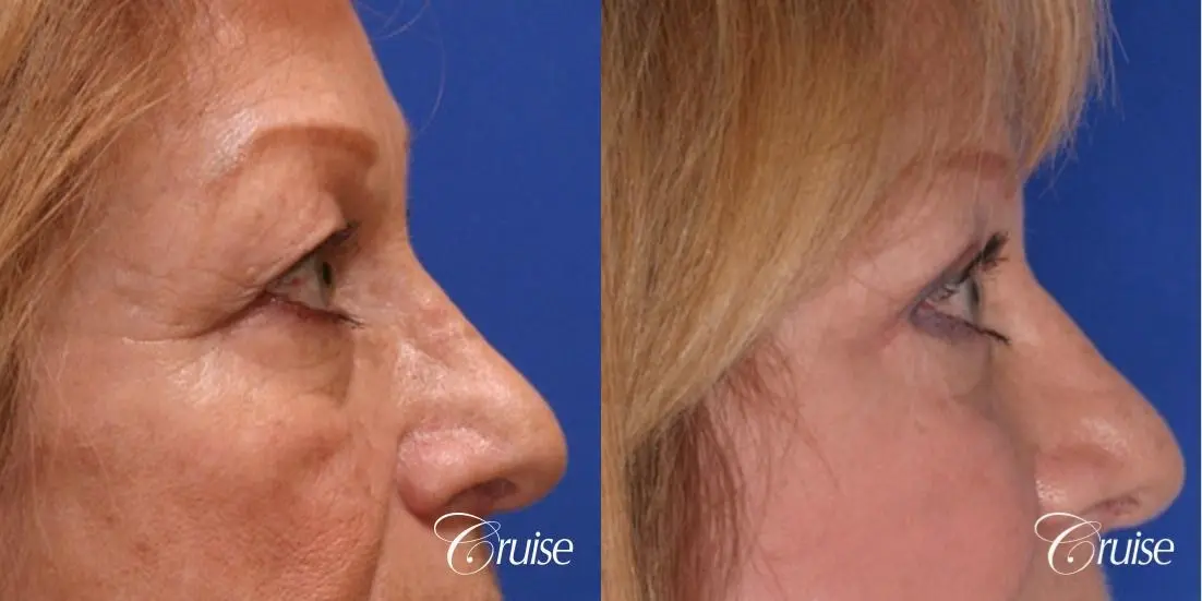 best upper eyelid plastic surgeon - Before and After 2