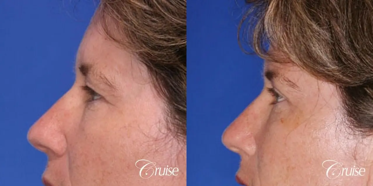 natural upper eyelid surgery - Before and After 2