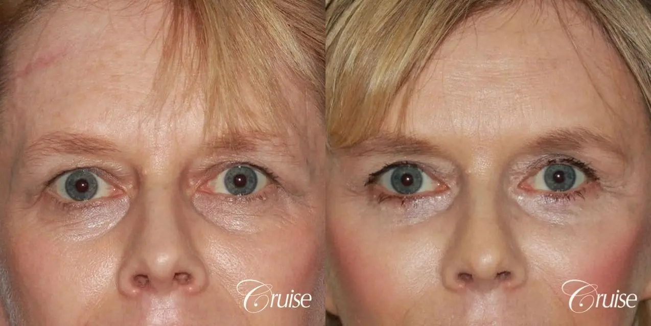 facelift with upper blepharoplasty - Before and After 1