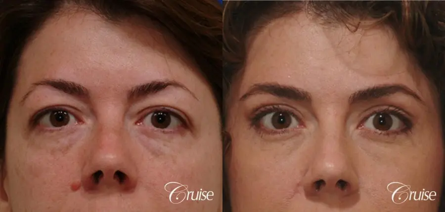 blepharoplasty specialist - Before and After