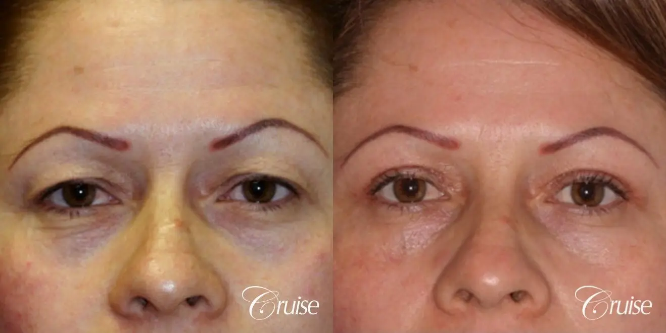 recovery on blepharoplasty - Before and After 1