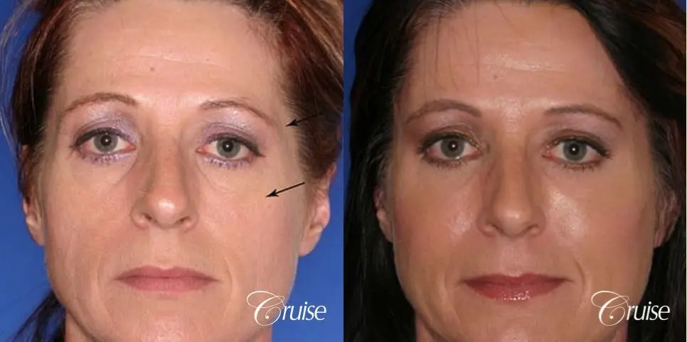 Blepharoplasty - Lower - Before and After 1