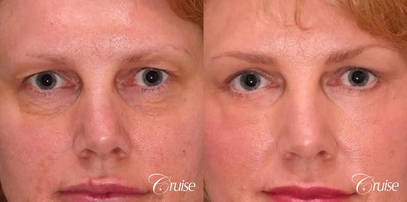 Blepharoplasty - Lower - Before and After 1