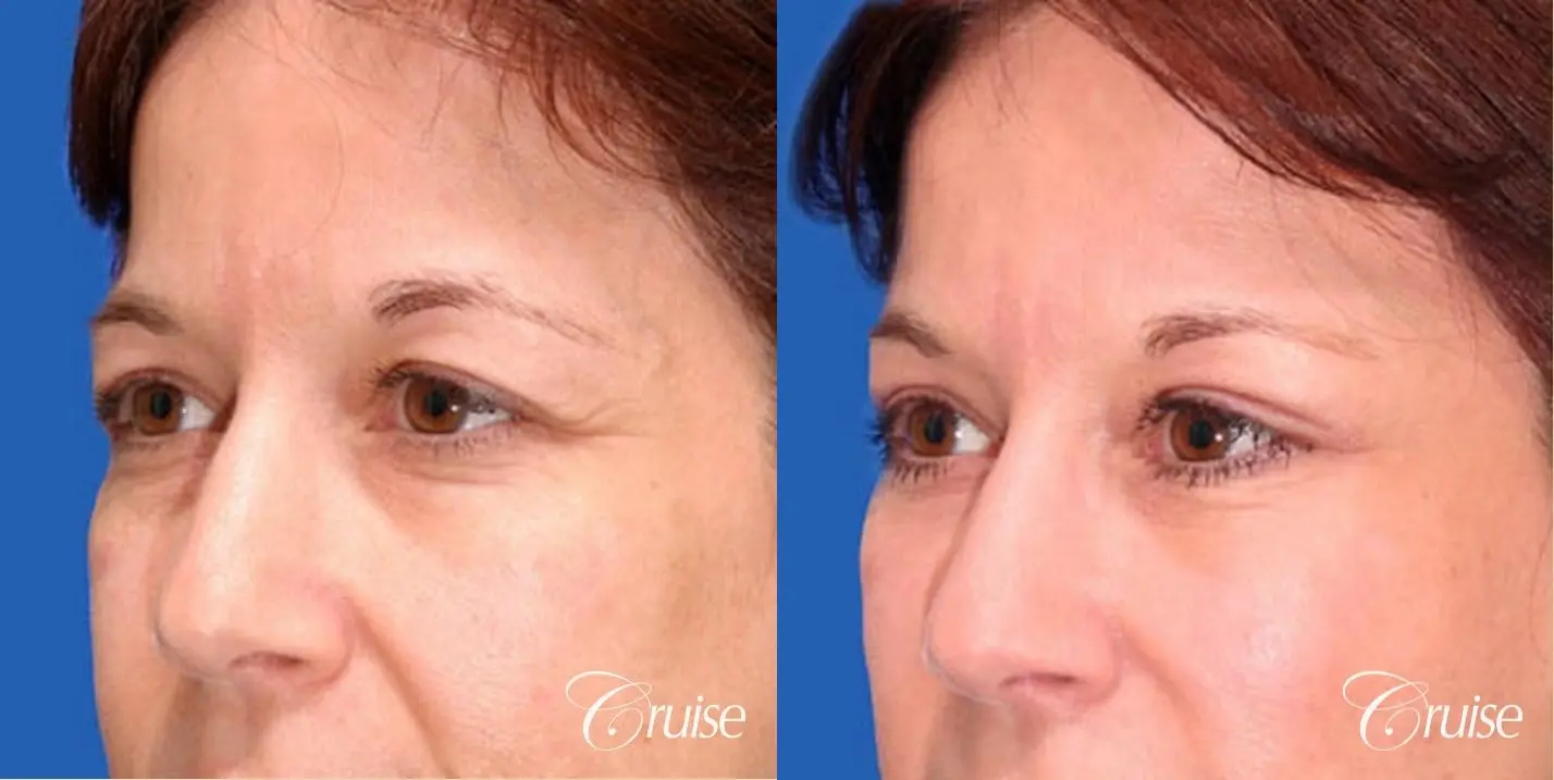 Blepharoplasty - Upper and Lower - Before and After 2
