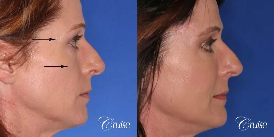 Blepharoplasty - Lower - Before and After 5