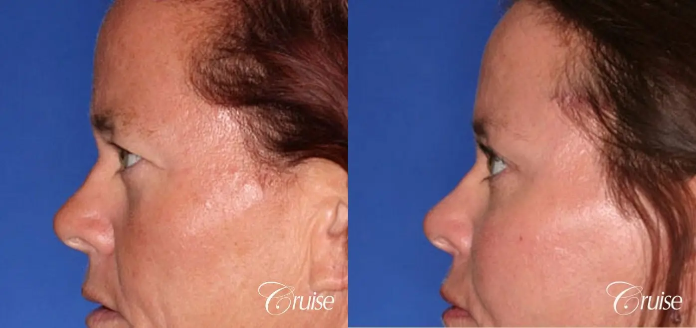 best results for upper blepharoplasty - Before and After 2