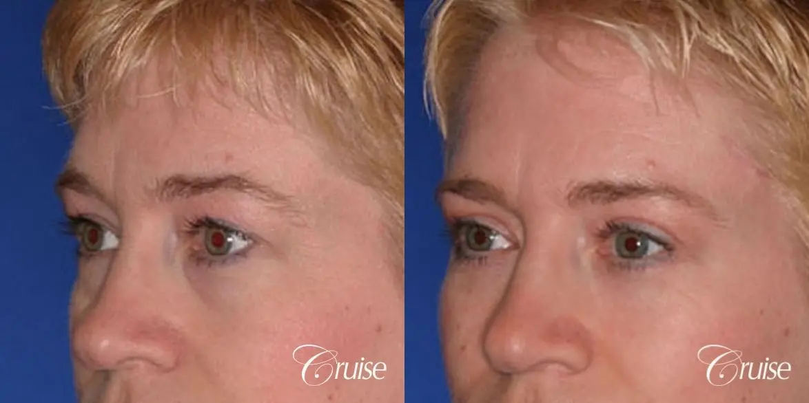 best specialist for upper eyelid surgery - Before and After 3