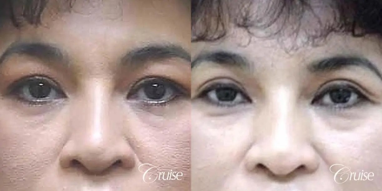 best female upper blepharoplasty photos - Before and After 1
