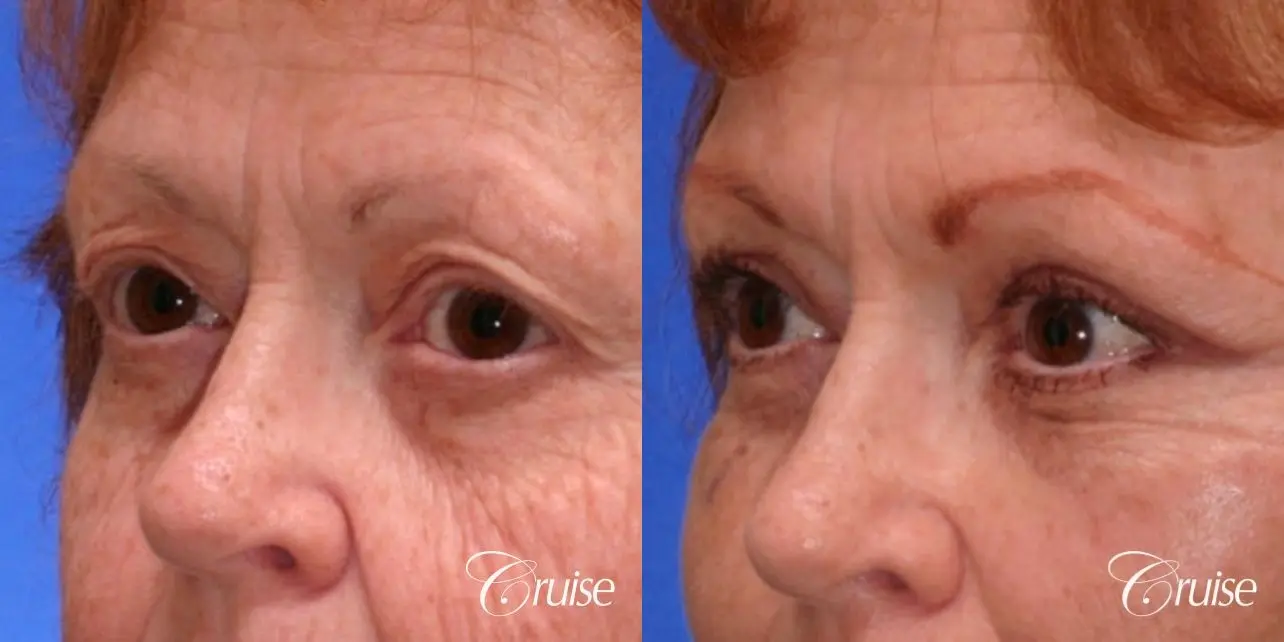 before and after pictures upper eyelid surgery - Before and After 2