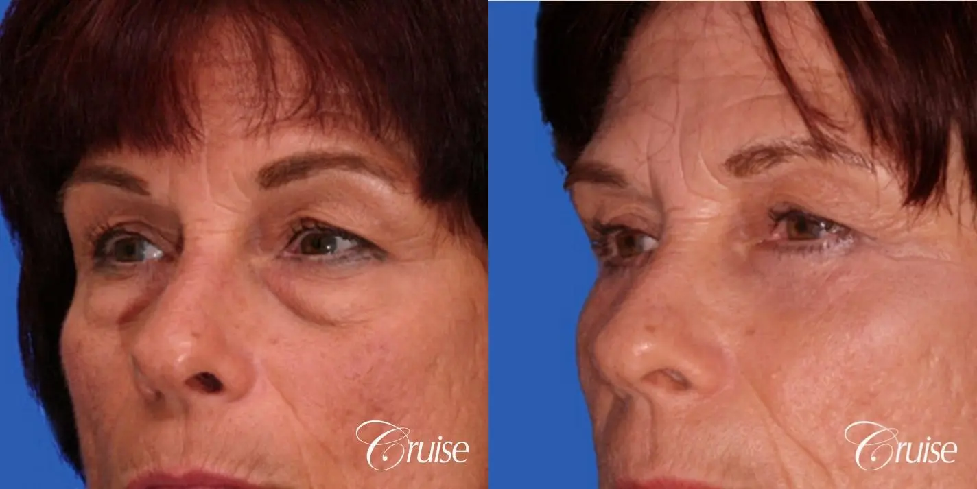 Blepharoplasty - Lower - Before and After 2