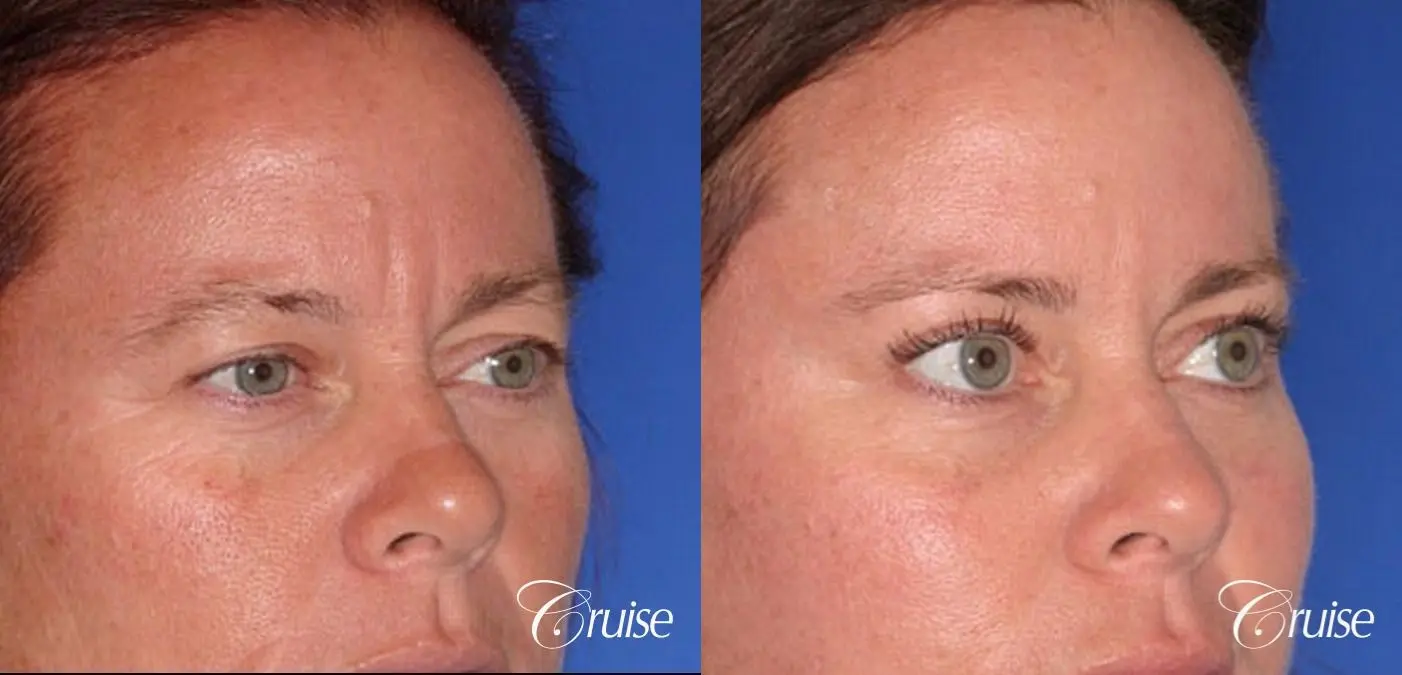 best results for upper blepharoplasty - Before and After 5