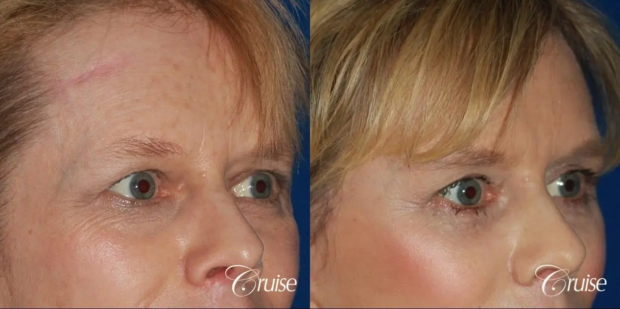 facelift with upper blepharoplasty - Before and After 3