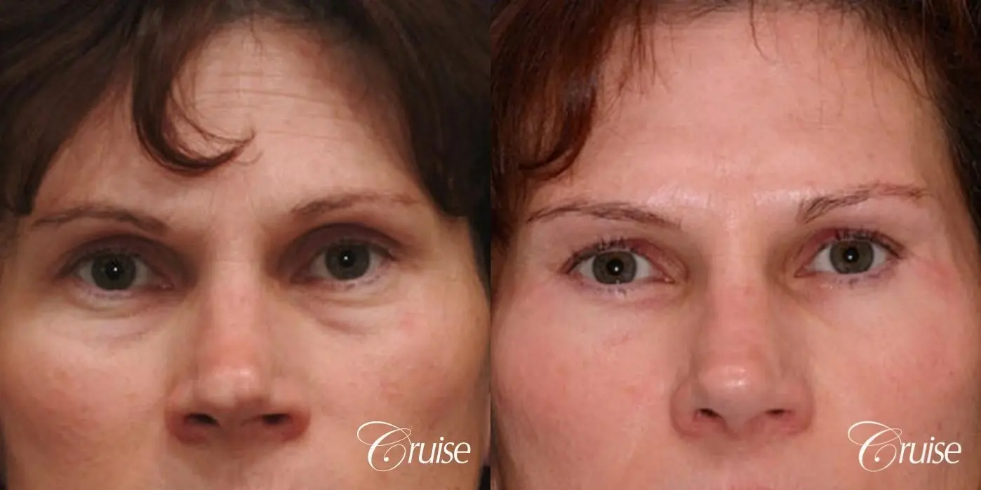Blepharoplasty - Lower  - Before and After 1