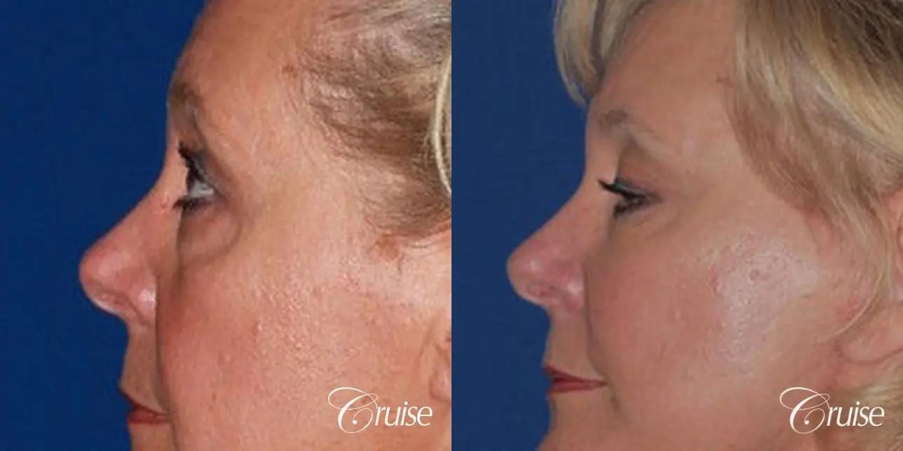 Blepharoplasty - Lower - Before and After 3