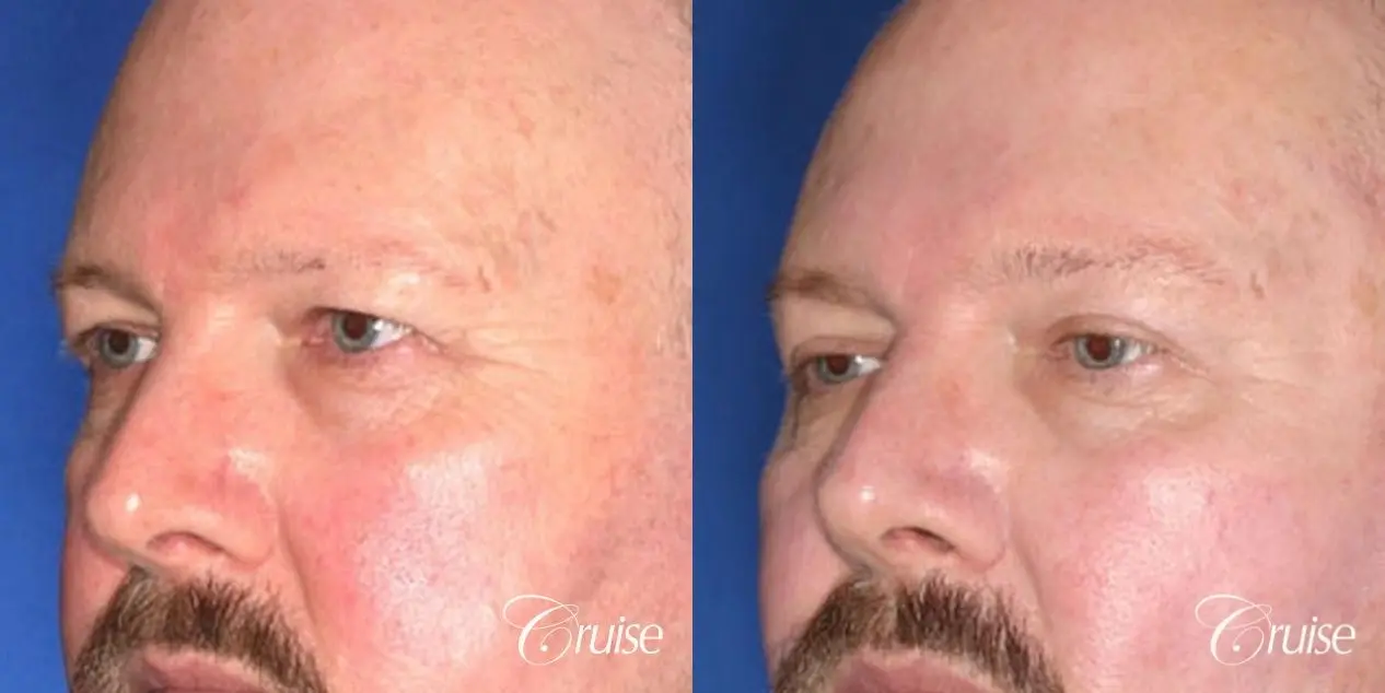 male with upper eye lid surgery pictures - Before and After 3