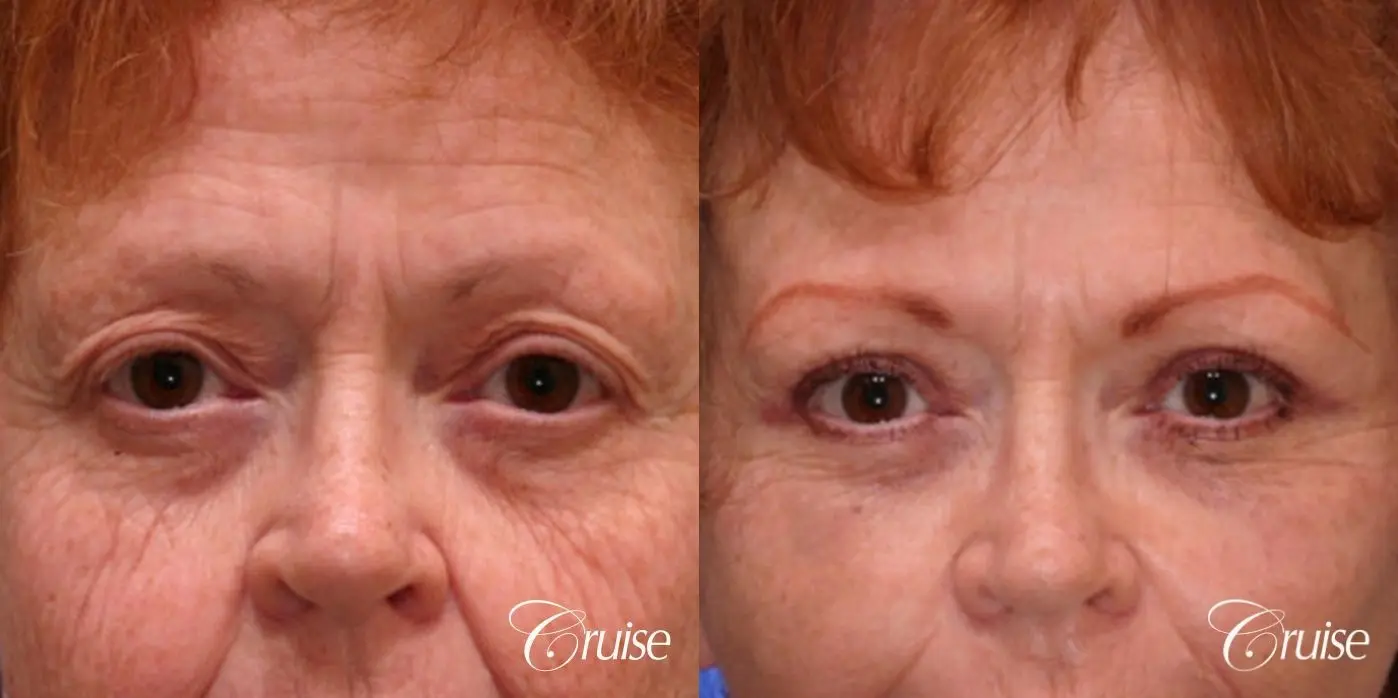 before and after pictures upper eyelid surgery - Before and After 1