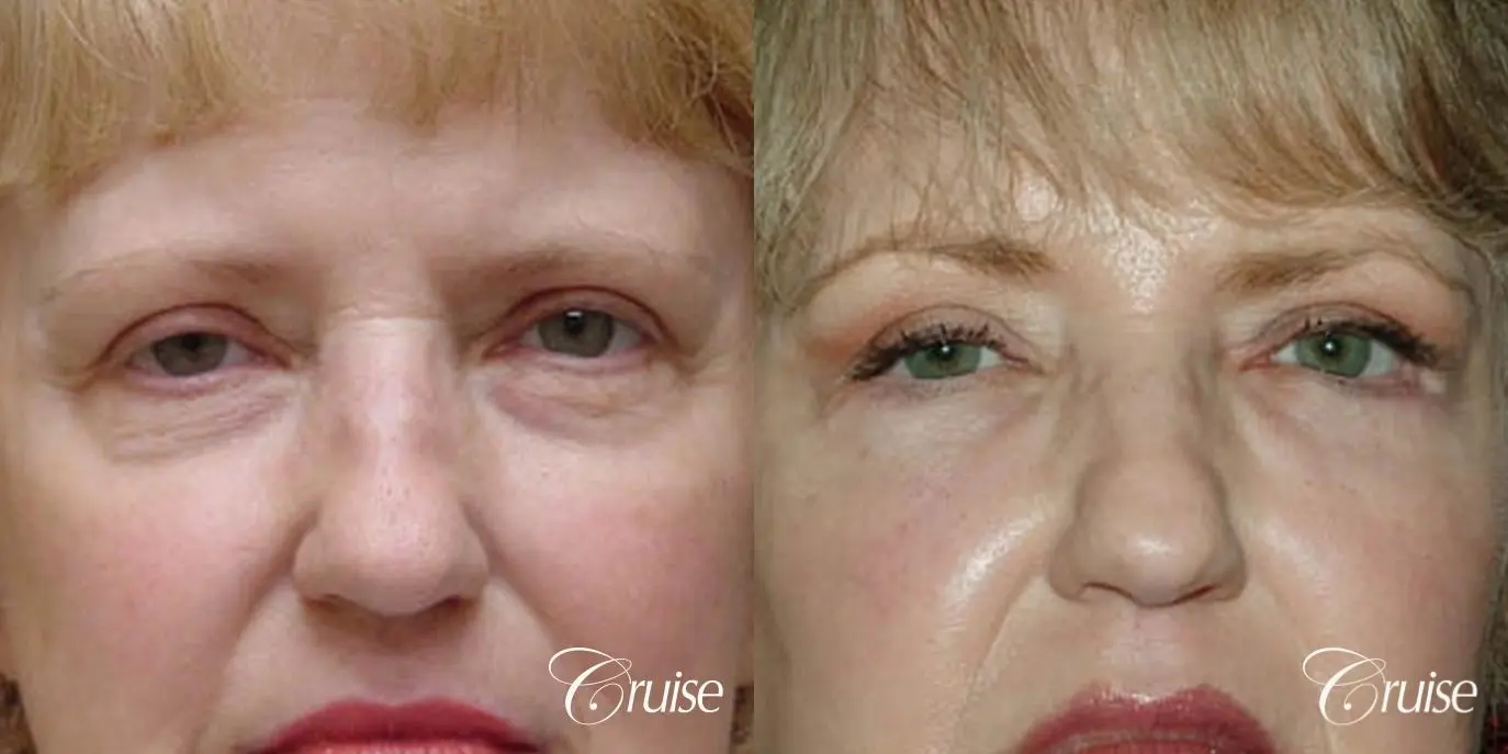 Blepharoplasty - Lower - Before and After 1