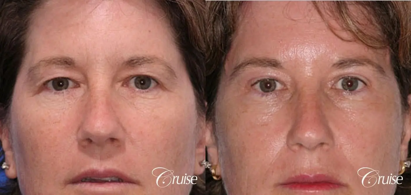 natural upper eyelid surgery - Before and After 1