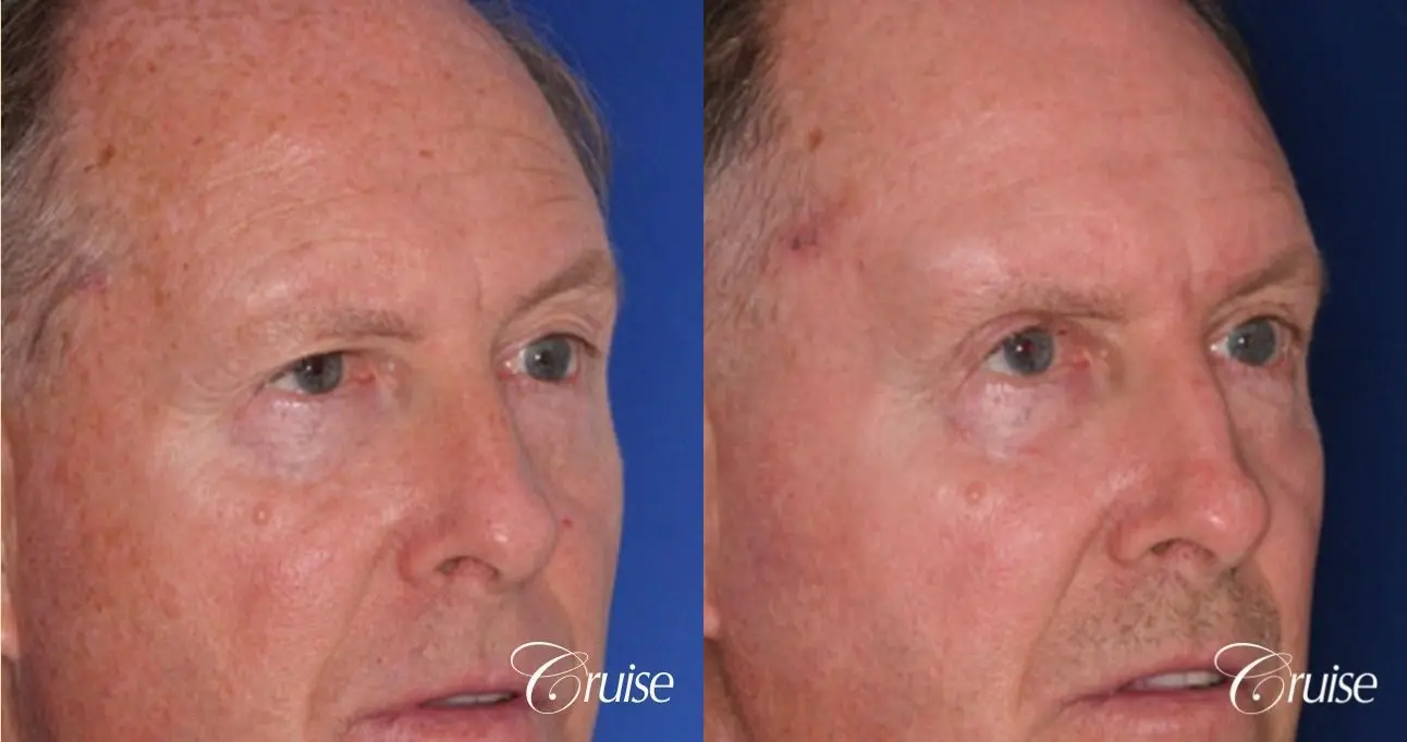 best upper eyelid surgery on a male patient - Before and After 3