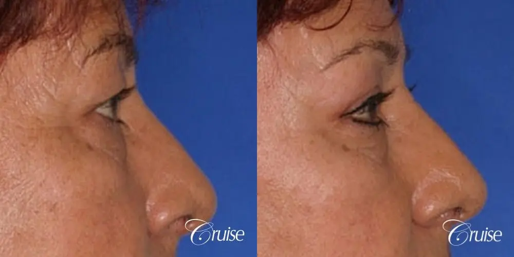 upper eyelid rejuvenation pictures - Before and After 3