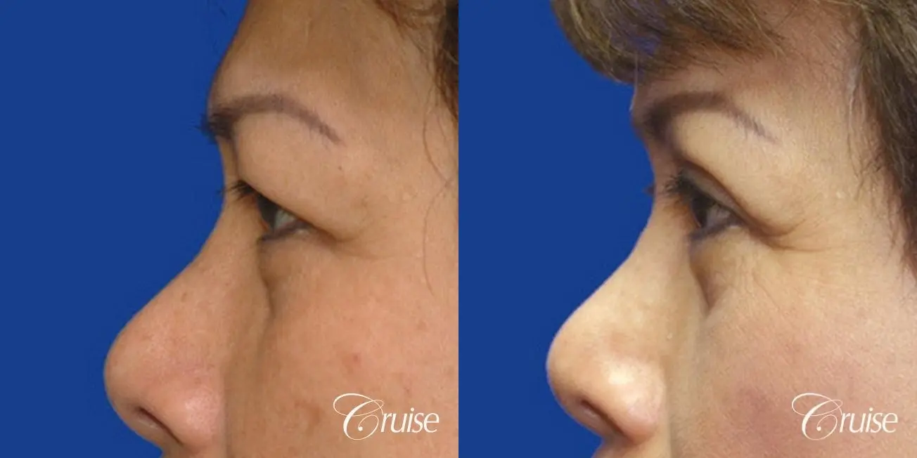 best Asian Upper eye lid plastic surgeon Newport Beach - Before and After 2