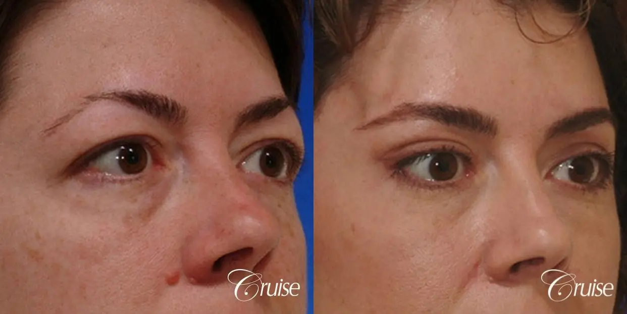blepharoplasty specialist - Before and After 3