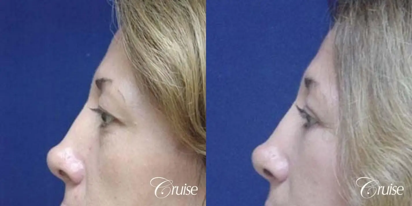 Blepharoplasty - Upper and Lower - Before and After 2