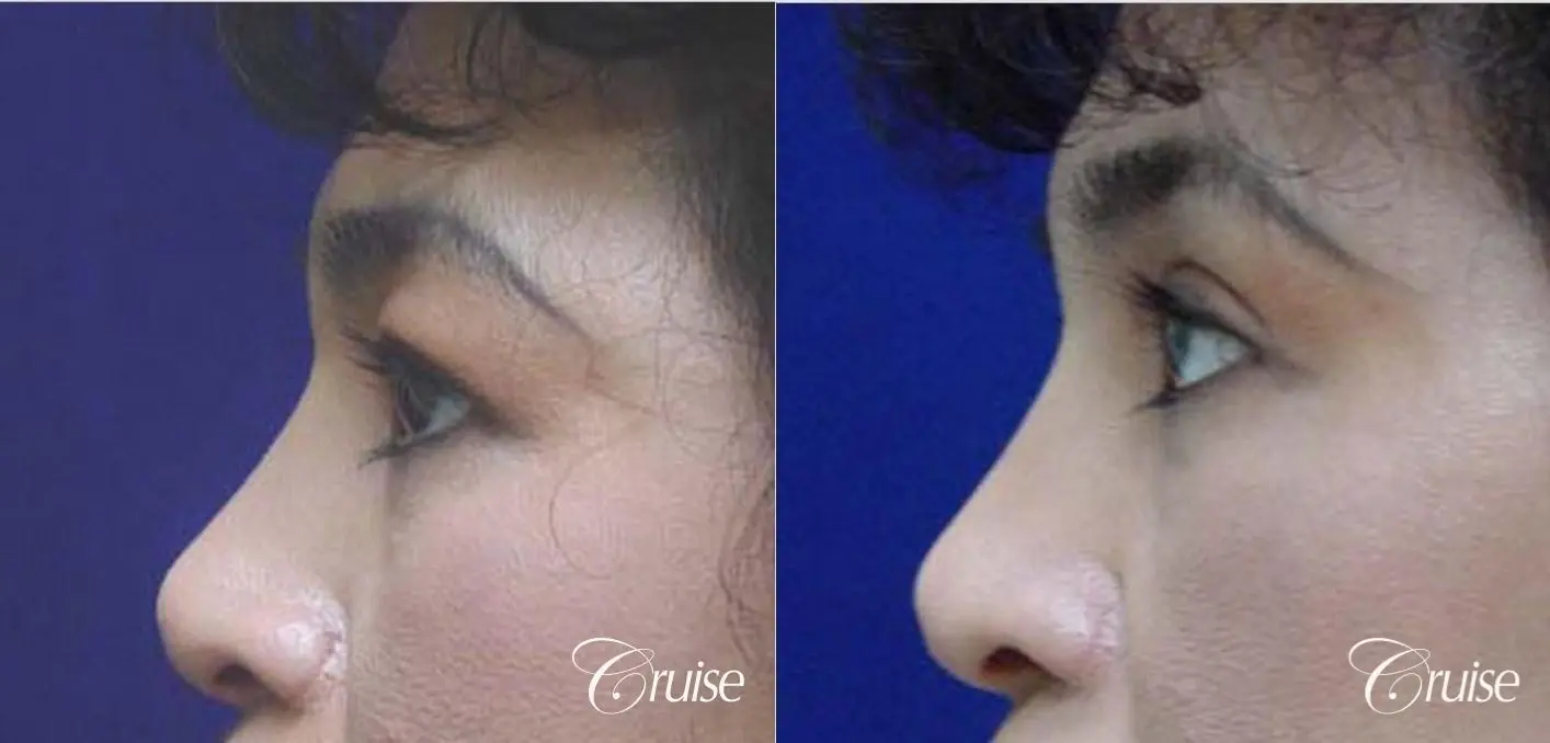 best female upper blepharoplasty photos - Before and After 2
