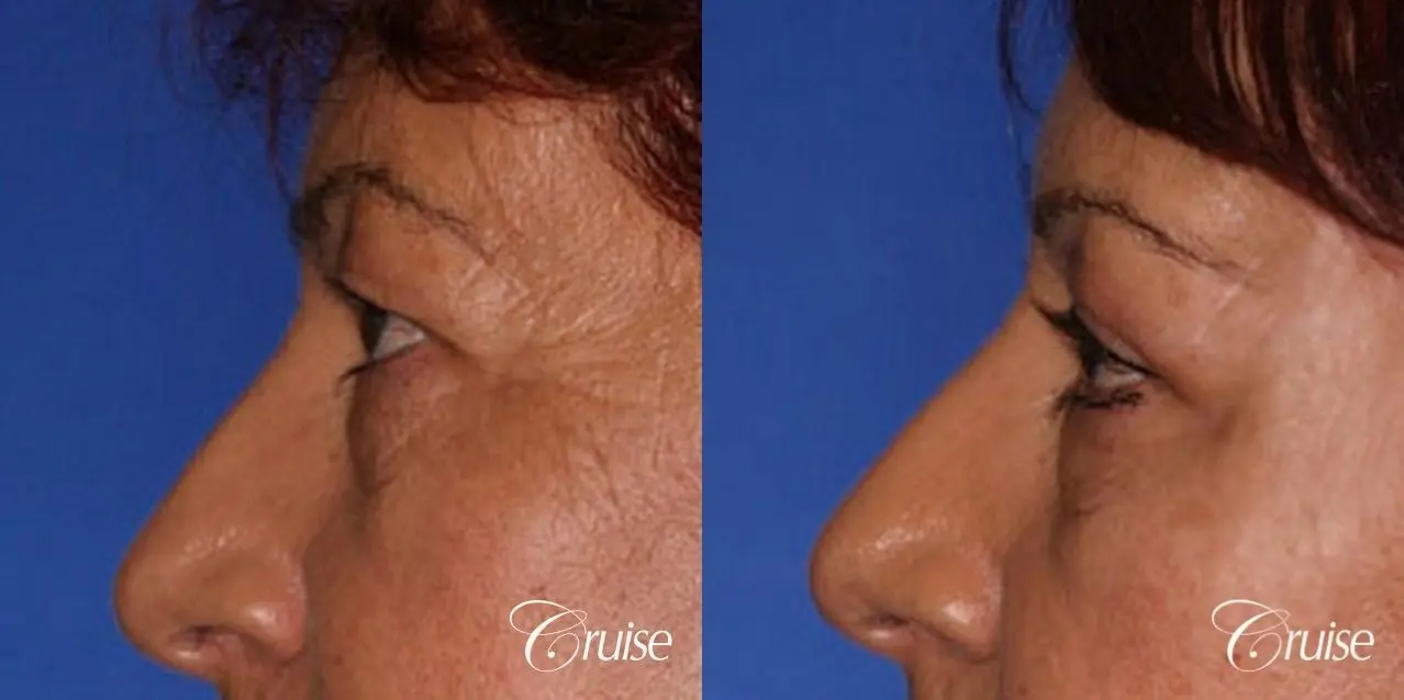 upper eyelid rejuvenation pictures - Before and After 2