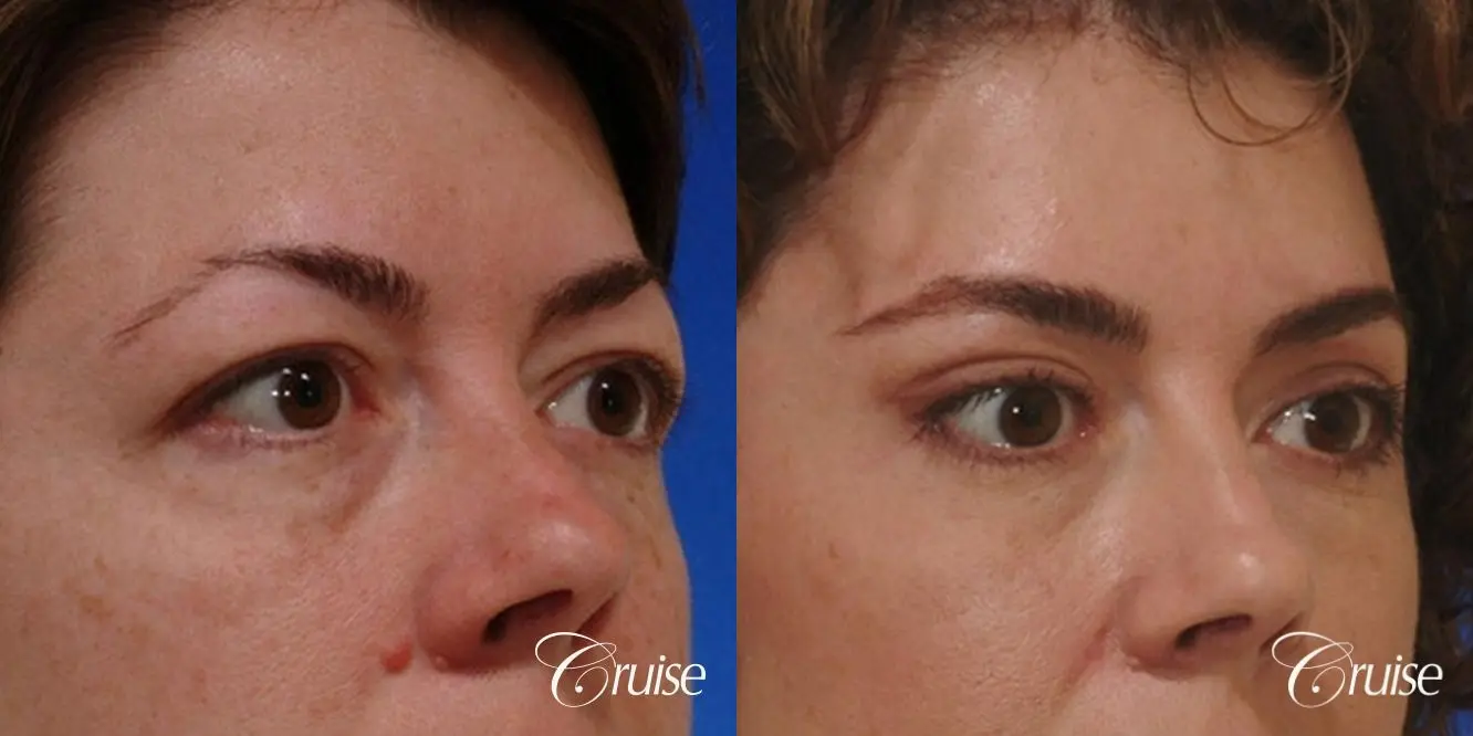 Blepharoplasty - Upper and Lower - Before and After 3