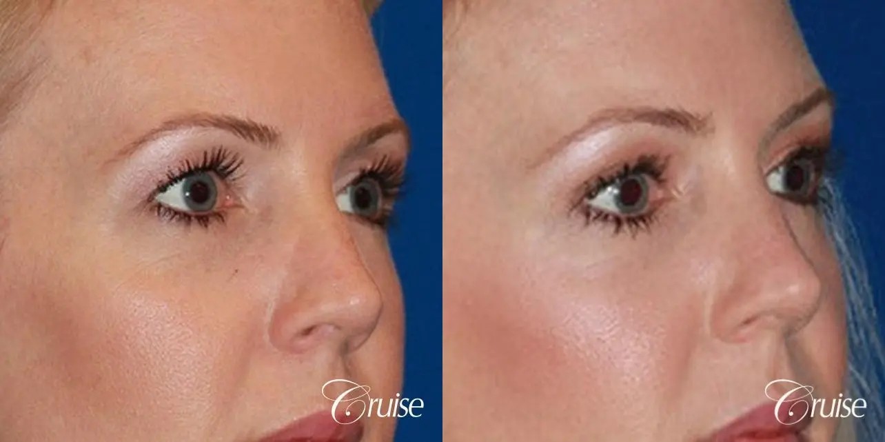 best upper eye lid results - Before and After 2