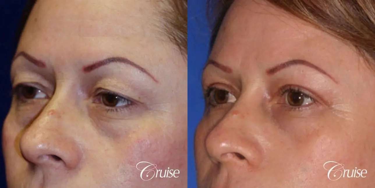 recovery on blepharoplasty - Before and After 3