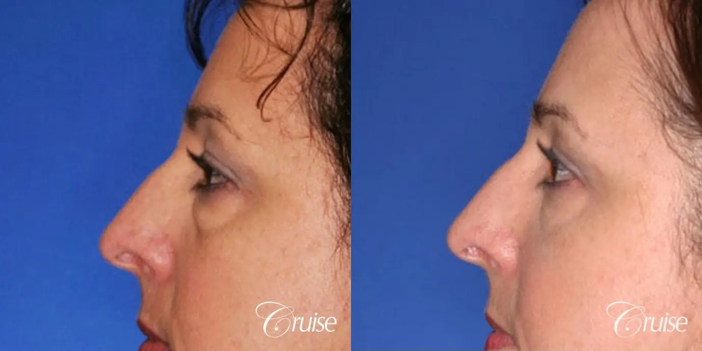 Blepharoplasty - Lower - Before and After 2