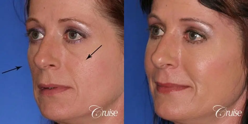 Blepharoplasty - Lower - Before and After 4