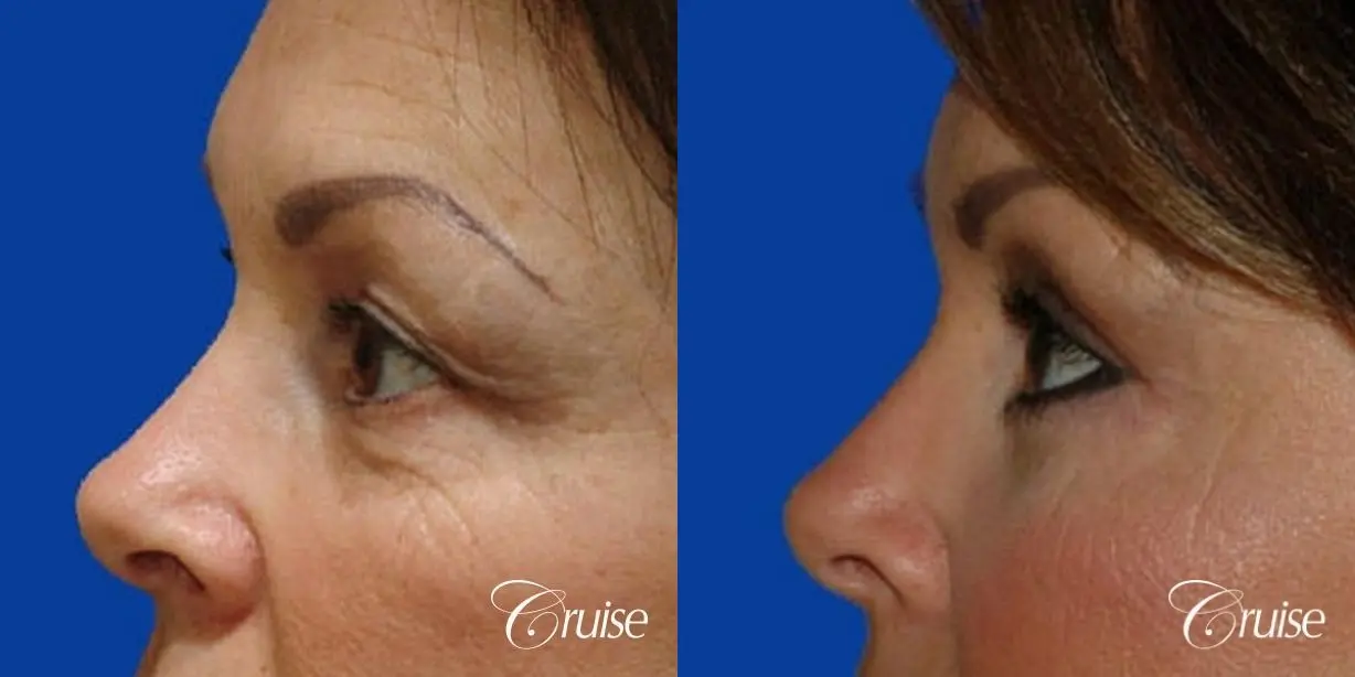Blepharoplasty - Lower - Before and After 2