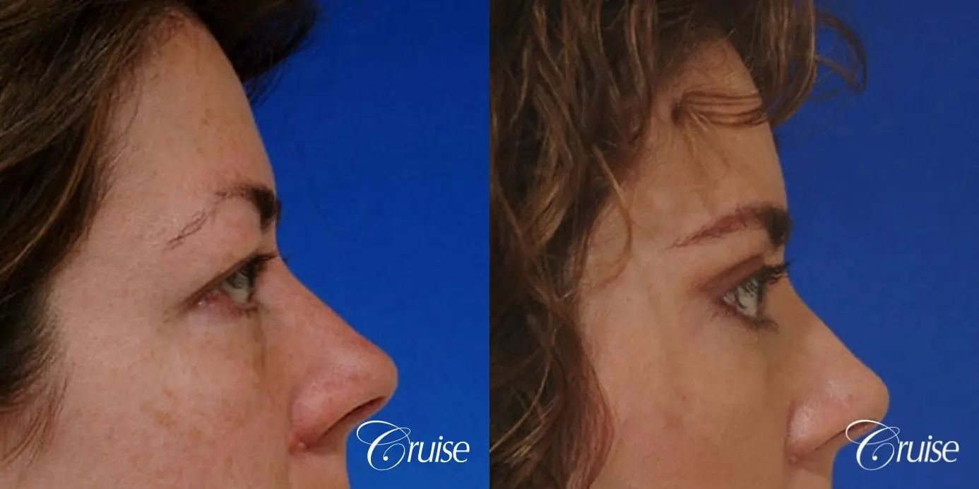 Blepharoplasty - Upper and Lower - Before and After 2